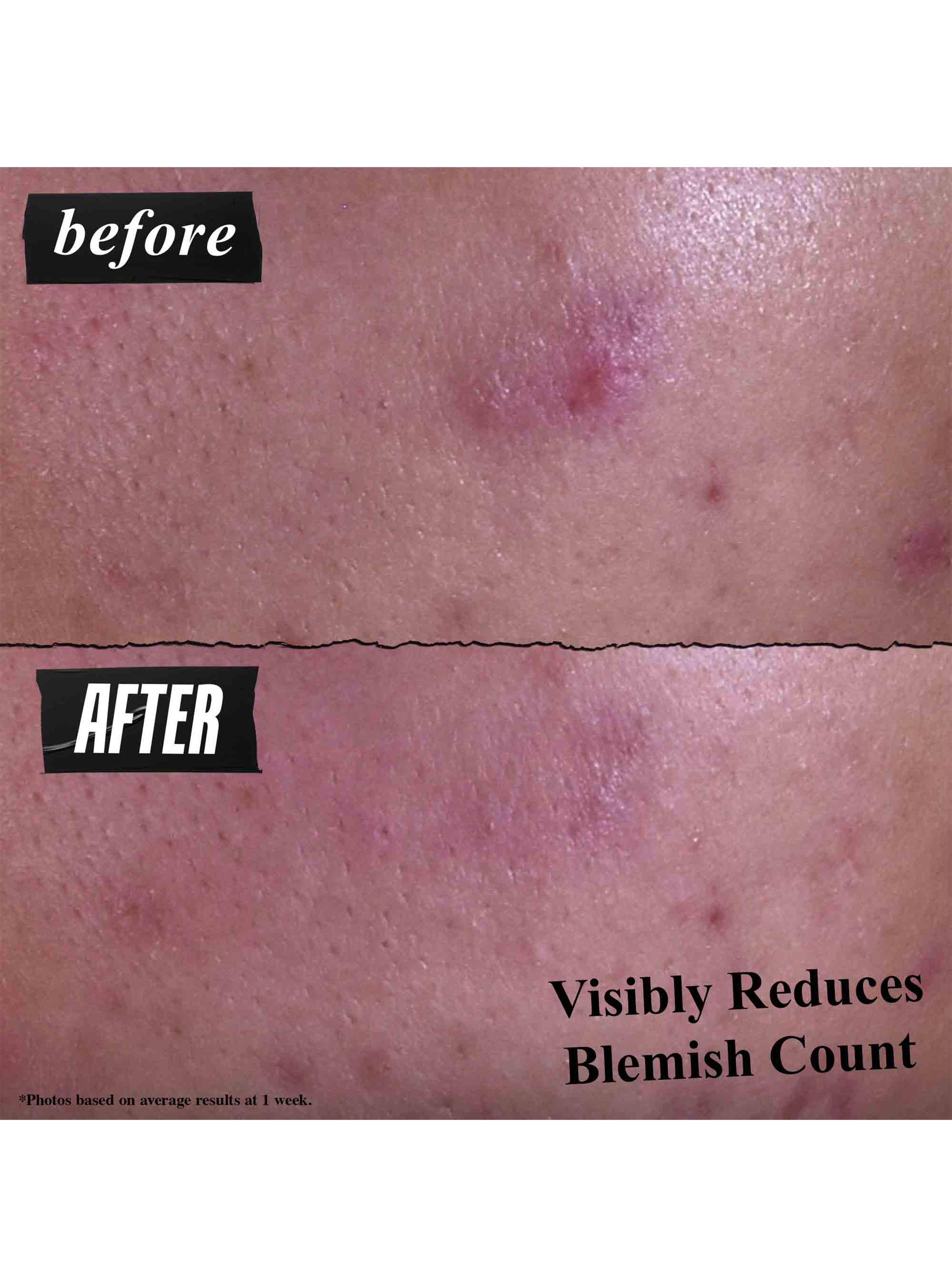 Gently Effective Blemish-Treating Cleansing Paste-3