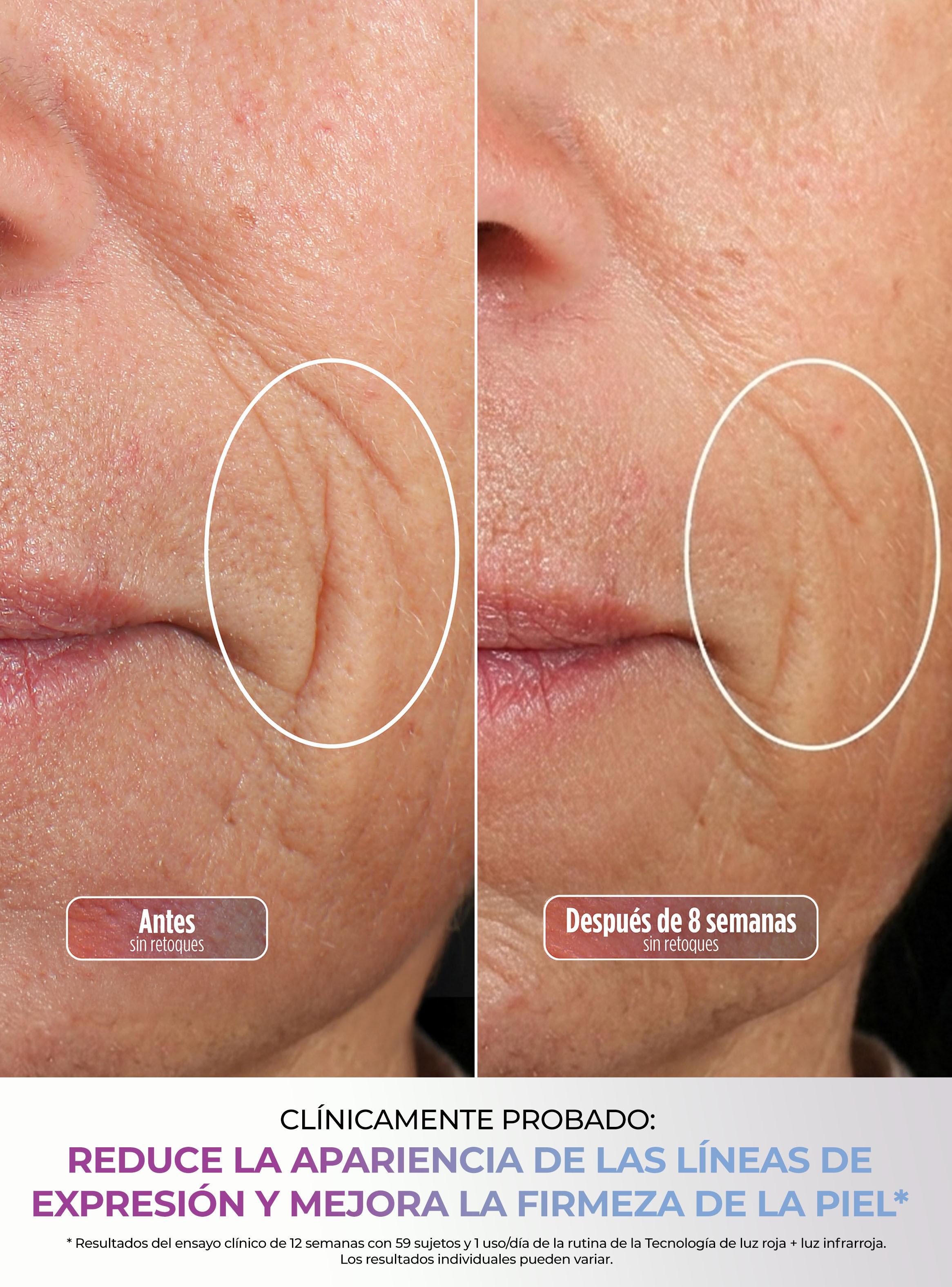 Máscara Facial LED CryoGlow con Enfriamiento-4
