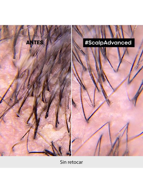 Shampoo Anti-Caspa Scalp Advanced 300ml-5