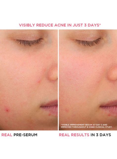 Serums Acné Bye Bye Breakout 30 ml-2